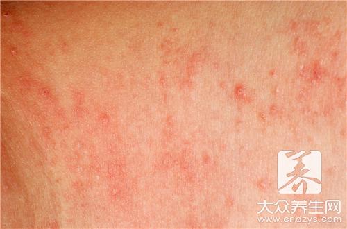 �촯��ʲôҩ�����